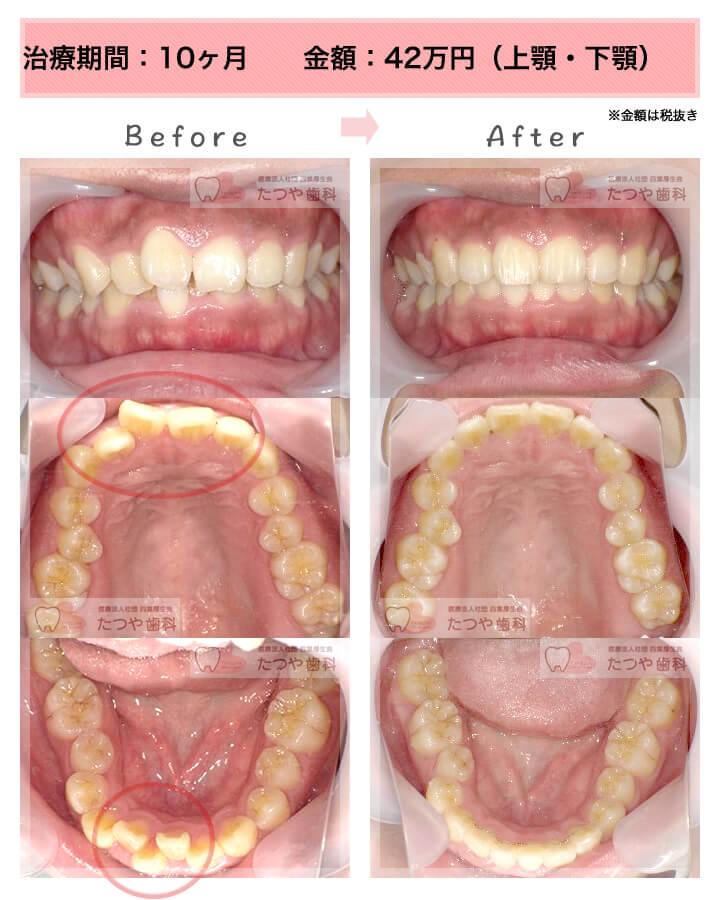 部分矯正の症例　上下の前歯
