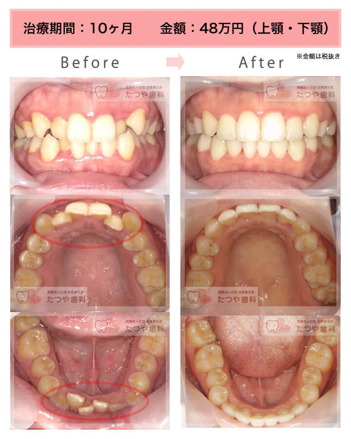 部分矯正の症例　上下の前歯