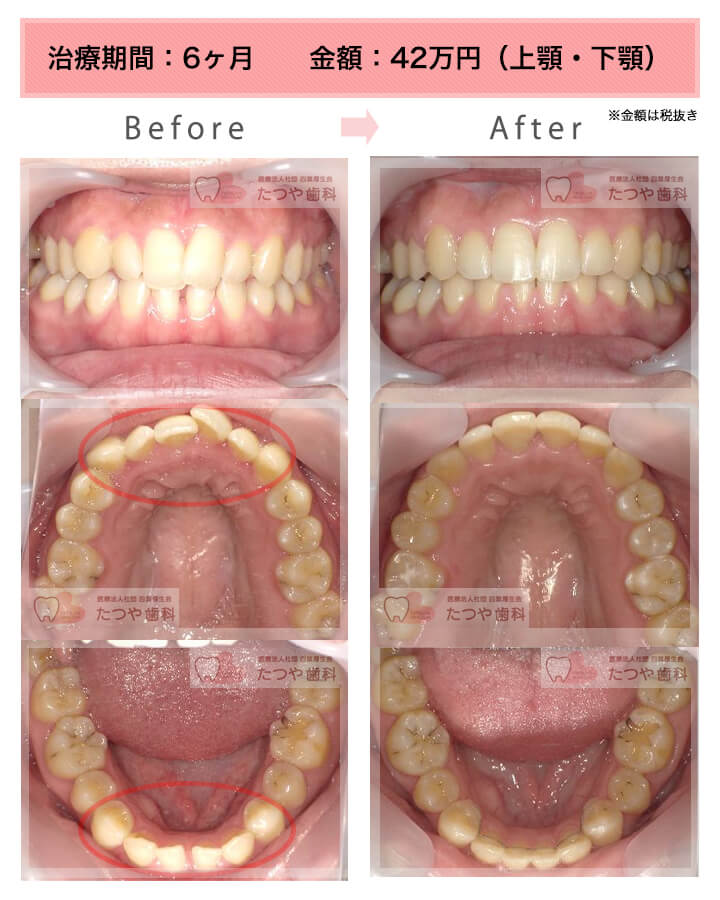 部分矯正の症例　上下の前歯