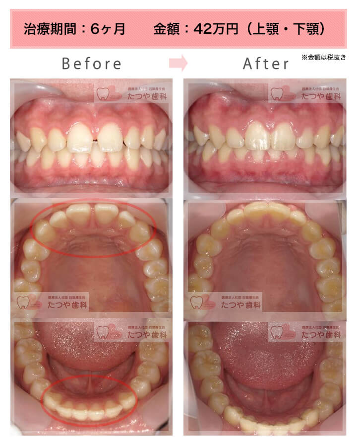 部分矯正の症例　上下の前歯