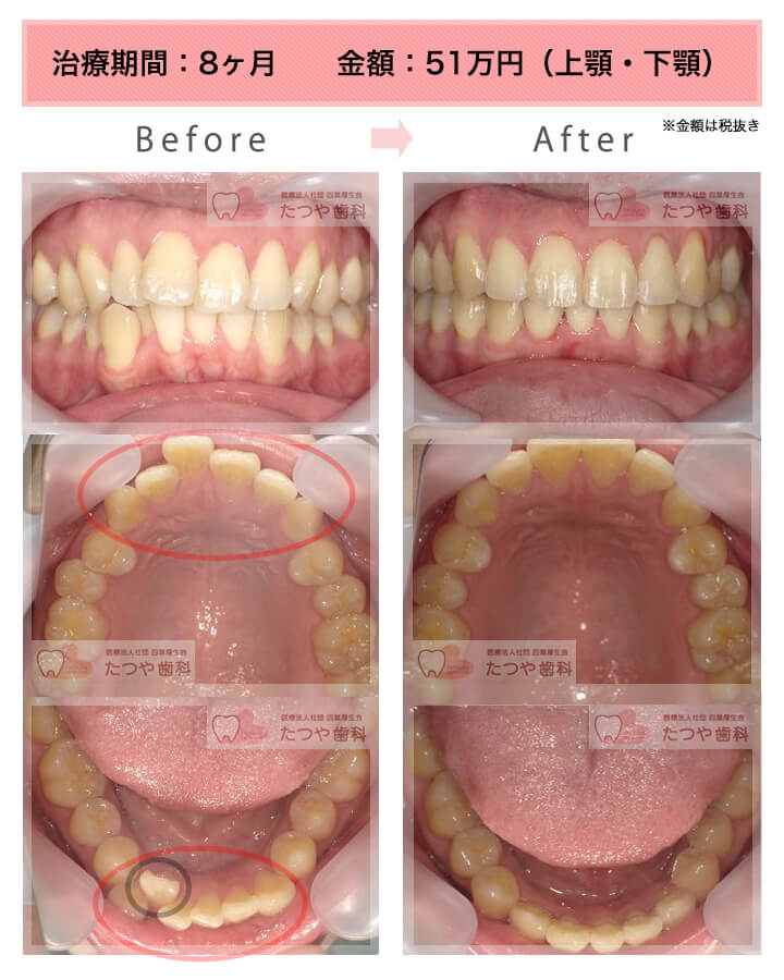 部分矯正の症例　上下の前歯