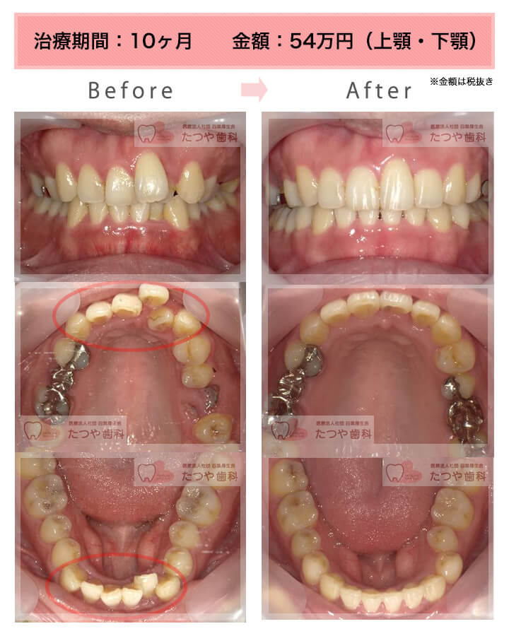 部分矯正の症例　上下の前歯