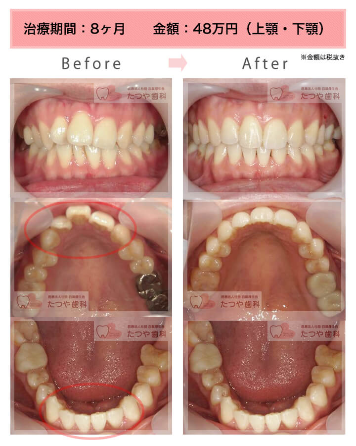 部分矯正の症例　上下の前歯