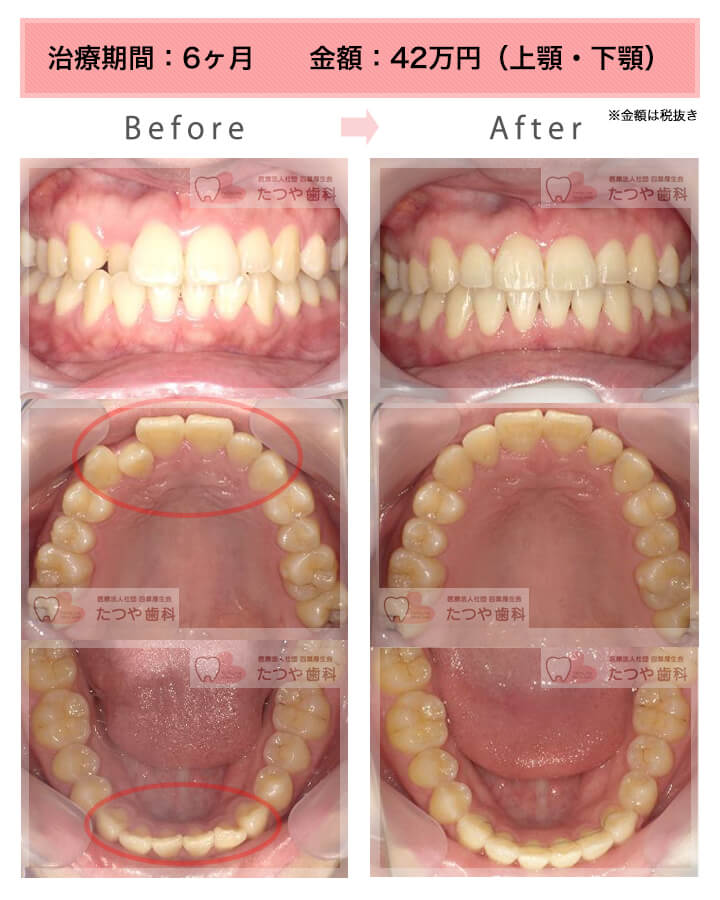 部分矯正の症例　上下の前歯