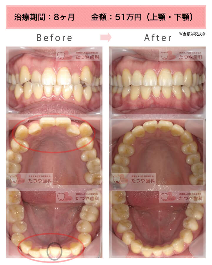 部分矯正の症例　上下の前歯