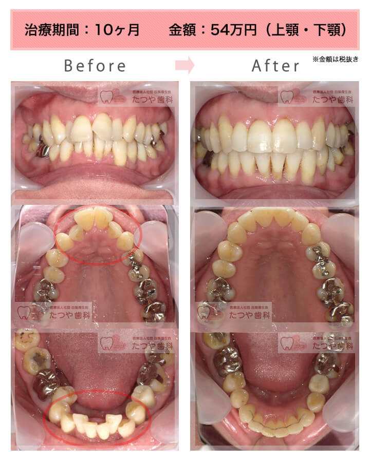 部分矯正の症例　上下の前歯