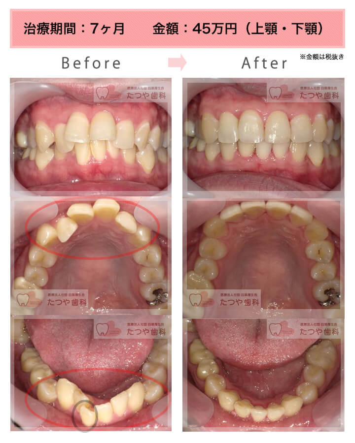 部分矯正の症例　上下の前歯