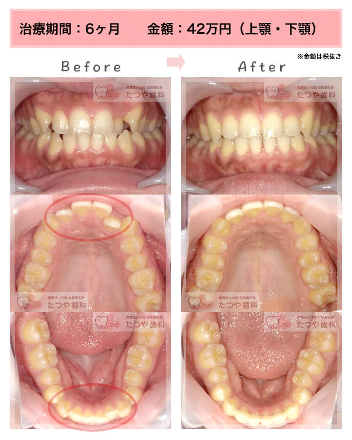 部分矯正の症例　上下の前歯