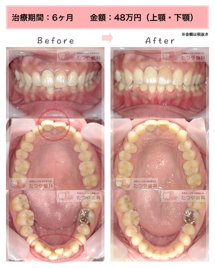 部分矯正の症例　上下の前歯