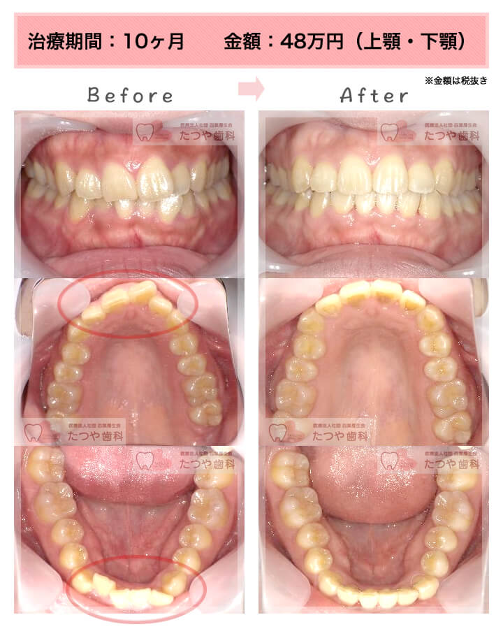 部分矯正の症例　上下の前歯