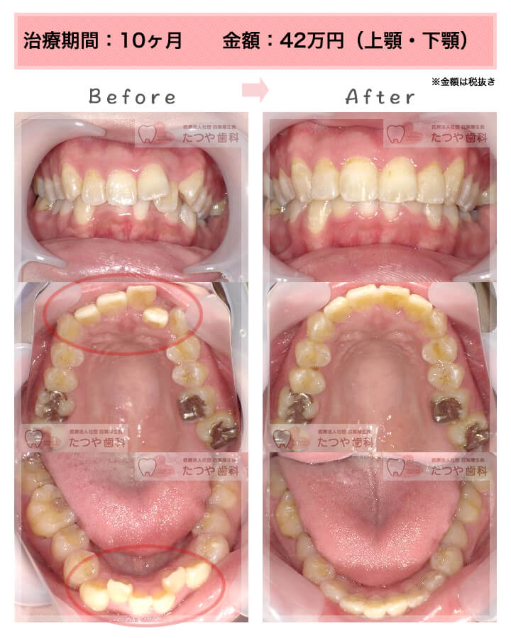 部分矯正の症例　上下の前歯