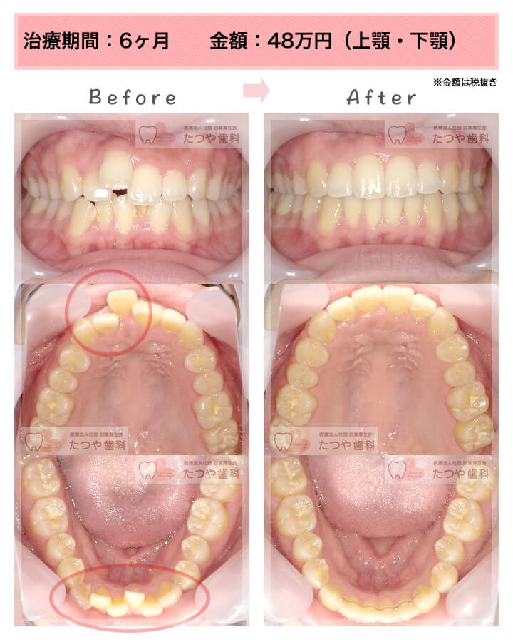 部分矯正の症例　上下の前歯