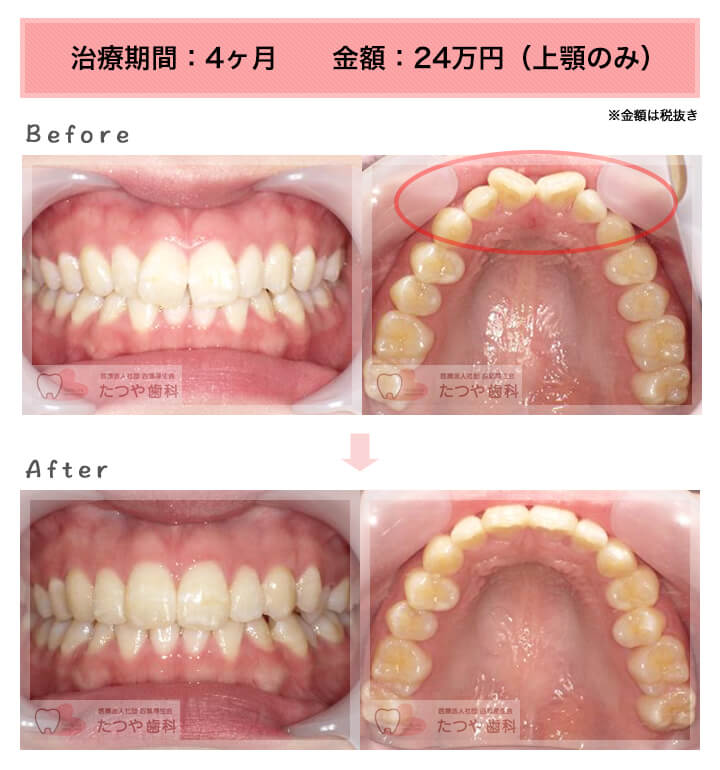 部分矯正の症例　前歯「逆八の字」