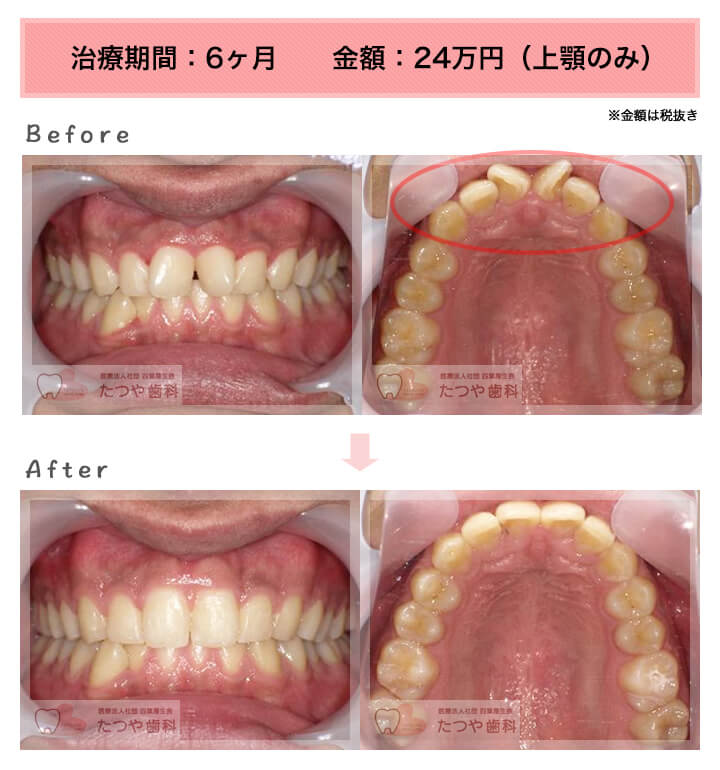 部分矯正の症例　前歯「逆八の字」