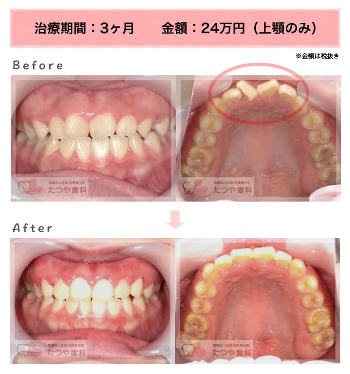 部分矯正の症例　前歯「逆八の字」