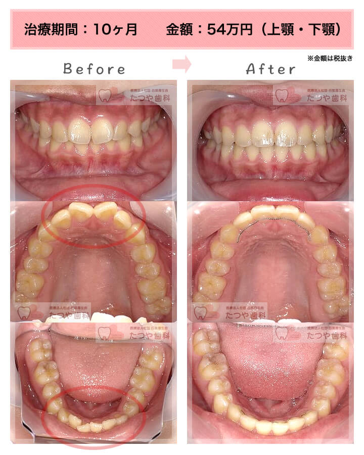 部分矯正の症例　前歯「逆八の字」