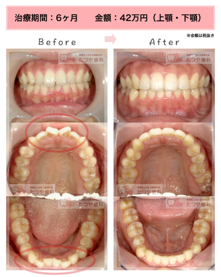 部分矯正の症例　前歯「逆八の字」