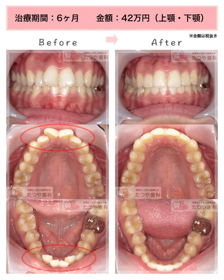 部分矯正の症例　前歯「逆八の字」