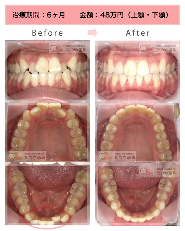 部分矯正の症例　前歯「逆八の字」