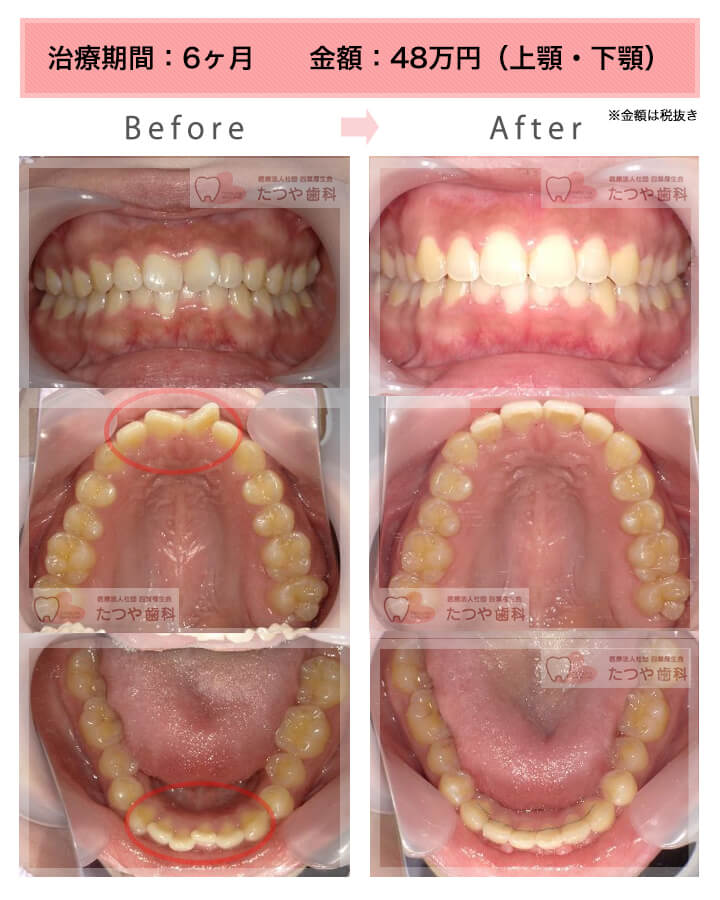 部分矯正の症例　前歯「逆八の字」