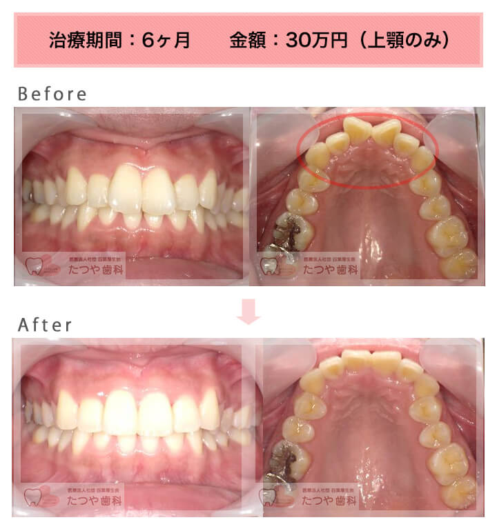 部分矯正の症例　前歯「逆八の字」