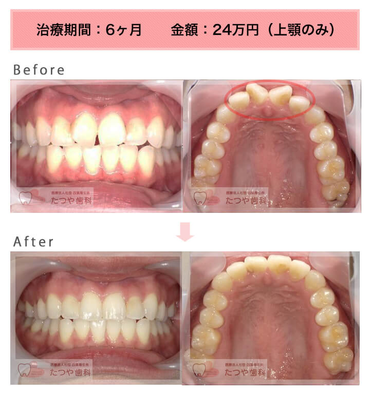 部分矯正の症例　前歯「逆八の字」