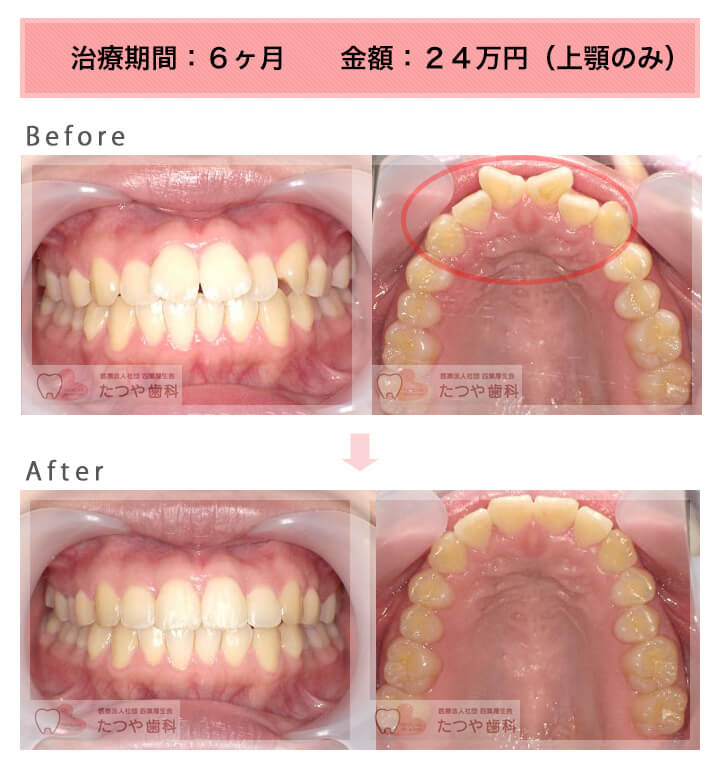 部分矯正の症例　前歯「逆八の字」