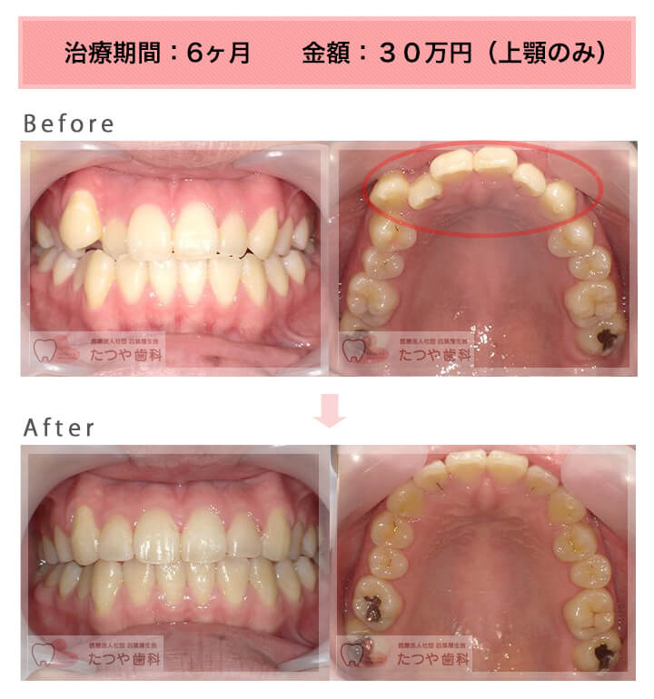 部分矯正の症例　前歯「逆八の字」