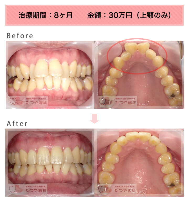 部分矯正の症例　前歯「逆八の字」
