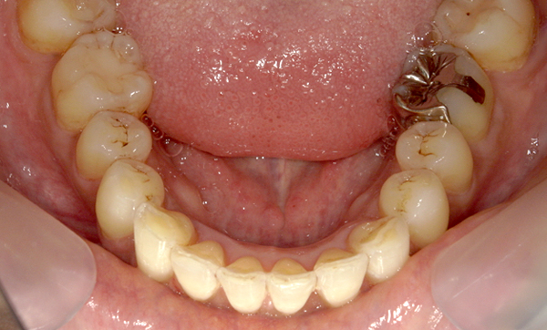 部分矯正 前歯「八の字/V字型」症例写真