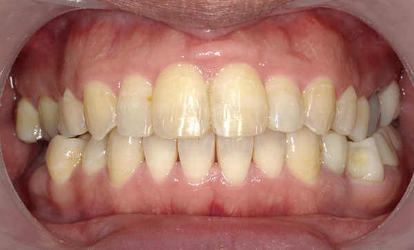 部分矯正 前歯「八の字/V字型」症例写真