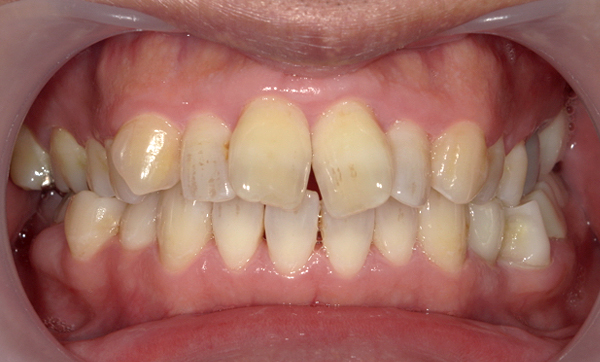 部分矯正 前歯「八の字/V字型」症例写真