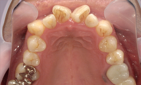 部分矯正 前歯「八の字/V字型」症例写真