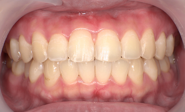 部分矯正 前歯「八の字/V字型」症例写真