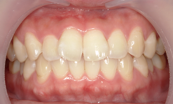 部分矯正 前歯「八の字/V字型」症例写真