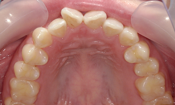 部分矯正 前歯「八の字/V字型」症例写真