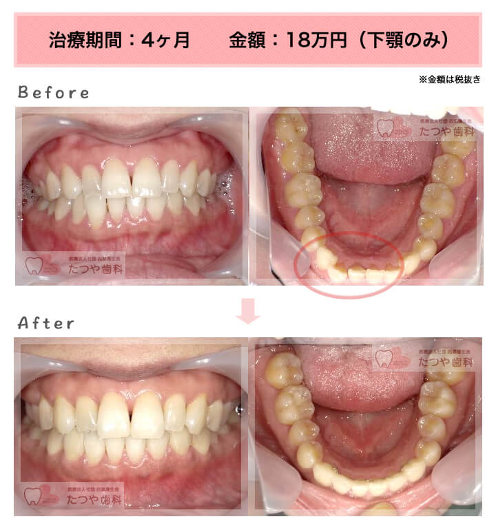 部分矯正の症例　下の前歯だけ