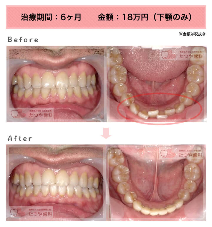 部分矯正の症例　下の前歯だけ