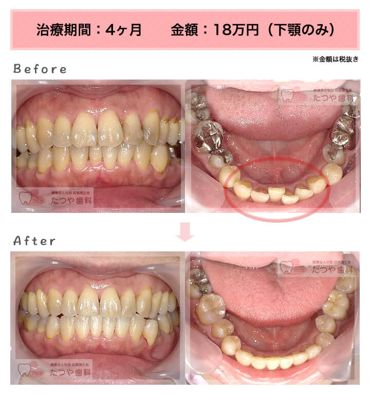 部分矯正の症例　下の前歯だけ