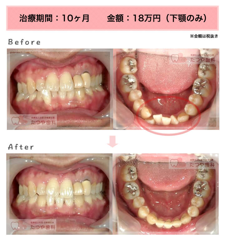 部分矯正の症例　下の前歯だけ