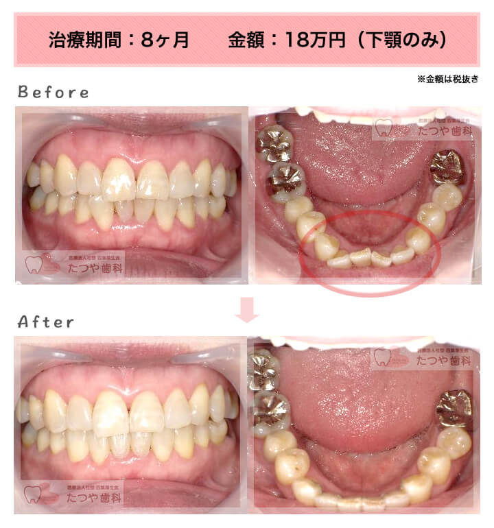 部分矯正の症例　下の前歯だけ