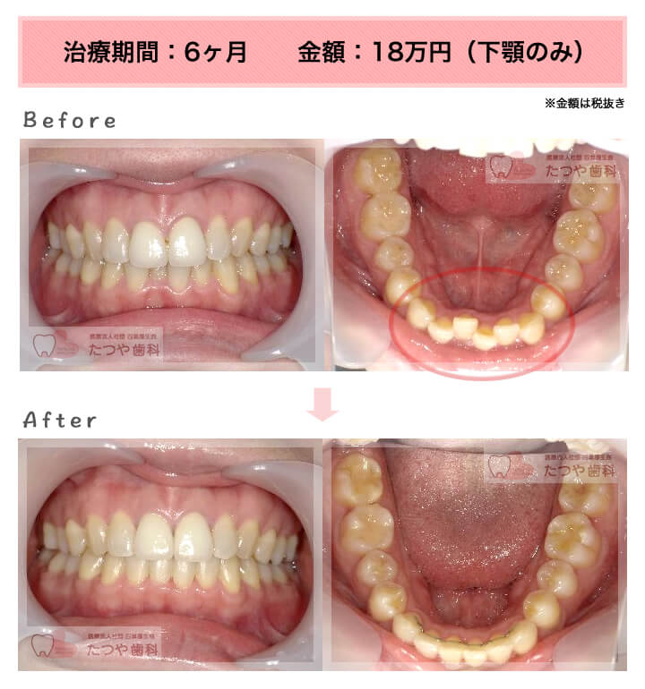 部分矯正の症例　下の前歯だけ