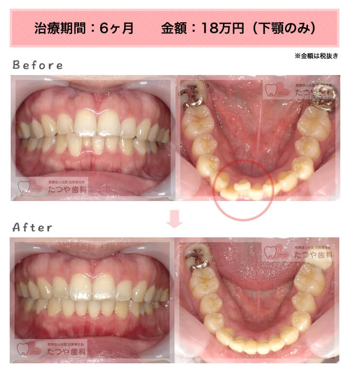 部分矯正の症例　下の前歯だけ