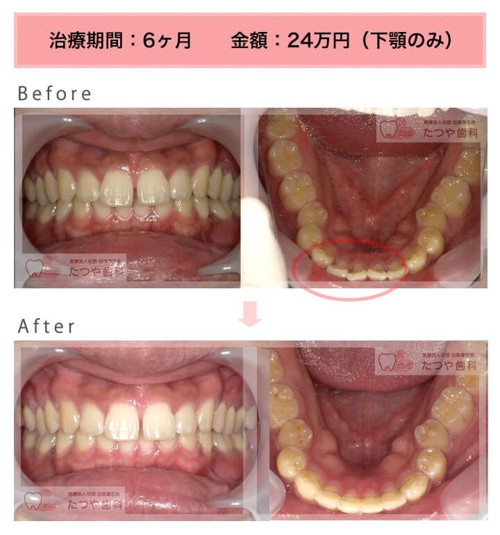 部分矯正の症例　下の前歯だけ