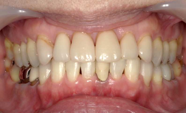 部分矯正 下の部分矯正の症例写真