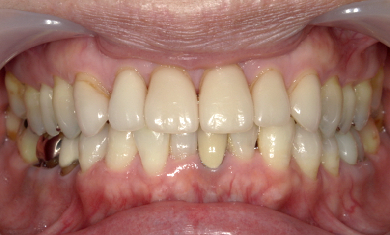 部分矯正 下の部分矯正の症例写真