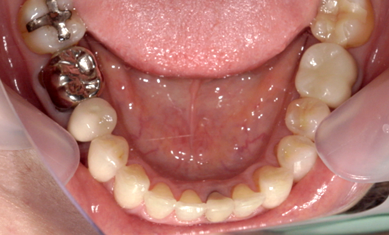 部分矯正 下の部分矯正の症例写真