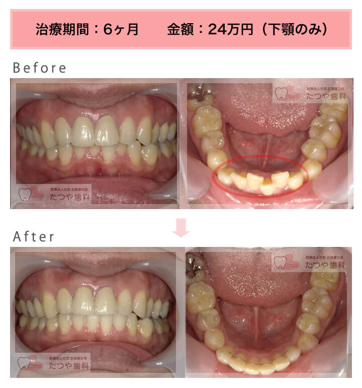 部分矯正の症例　下の前歯だけ