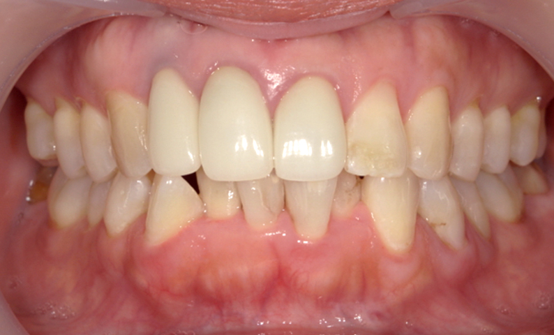 部分矯正 下の部分矯正の症例写真