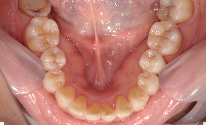 部分矯正 下の部分矯正の症例写真